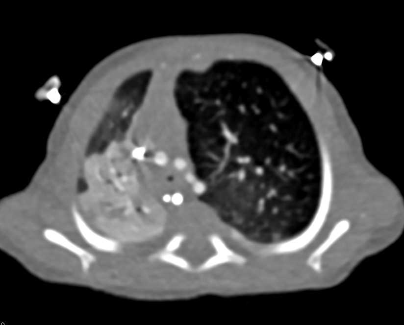 Occluded Right Upper Lobe Bronchus due to Stenosis - CTisus CT Scan