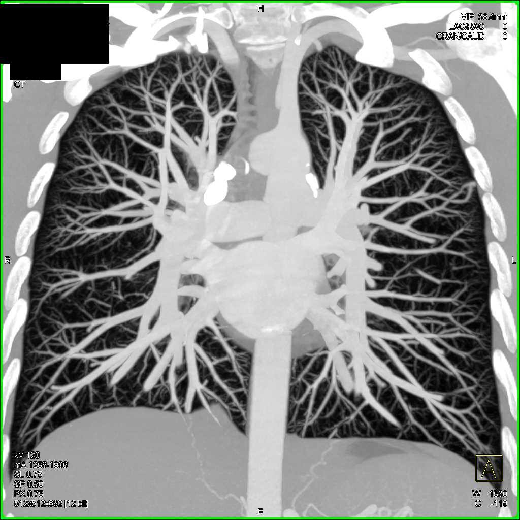 Small Pulmonary Arteriovenous Malformations (AVMs) in a Hereditary Hemorrhagic Telangiectasia (HHT) Patient - CTisus CT Scan