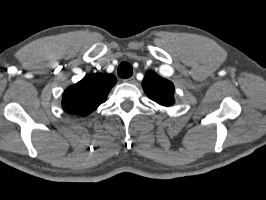 Left Subclavian Artery Aneurysm - CTisus CT Scan