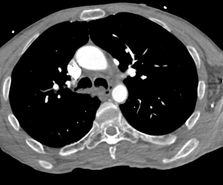 Mucous in Trachea with Aspiration - CTisus CT Scan