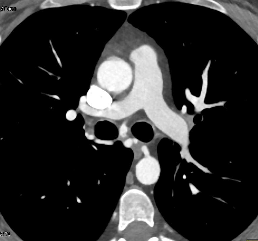 Dilated Bronchial Arteries - CTisus CT Scan
