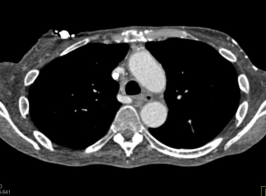 Venous Catheter with Clot in Superior Vena Cava (SVC) - CTisus CT Scan