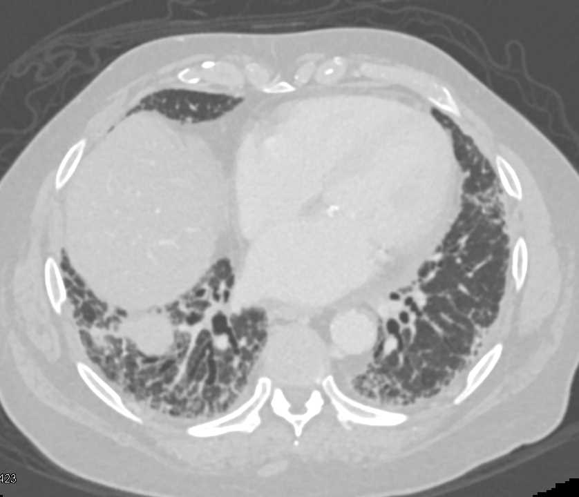 Idiopathic Pulmonary Fibrosis (IPF) Lungs - CTisus CT Scan