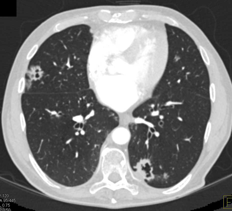 Septic Emboli - CTisus CT Scan