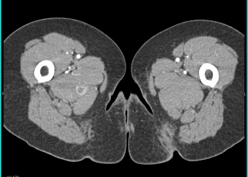 Primary Breast Cancer with Muscle Metastases - CTisus CT Scan
