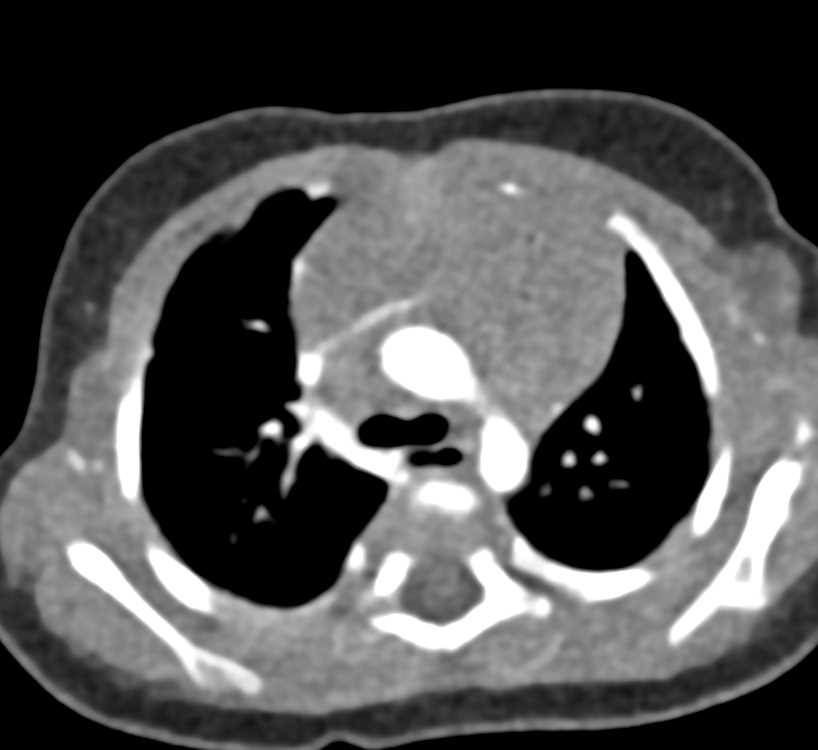 Thymoma - CTisus CT Scan