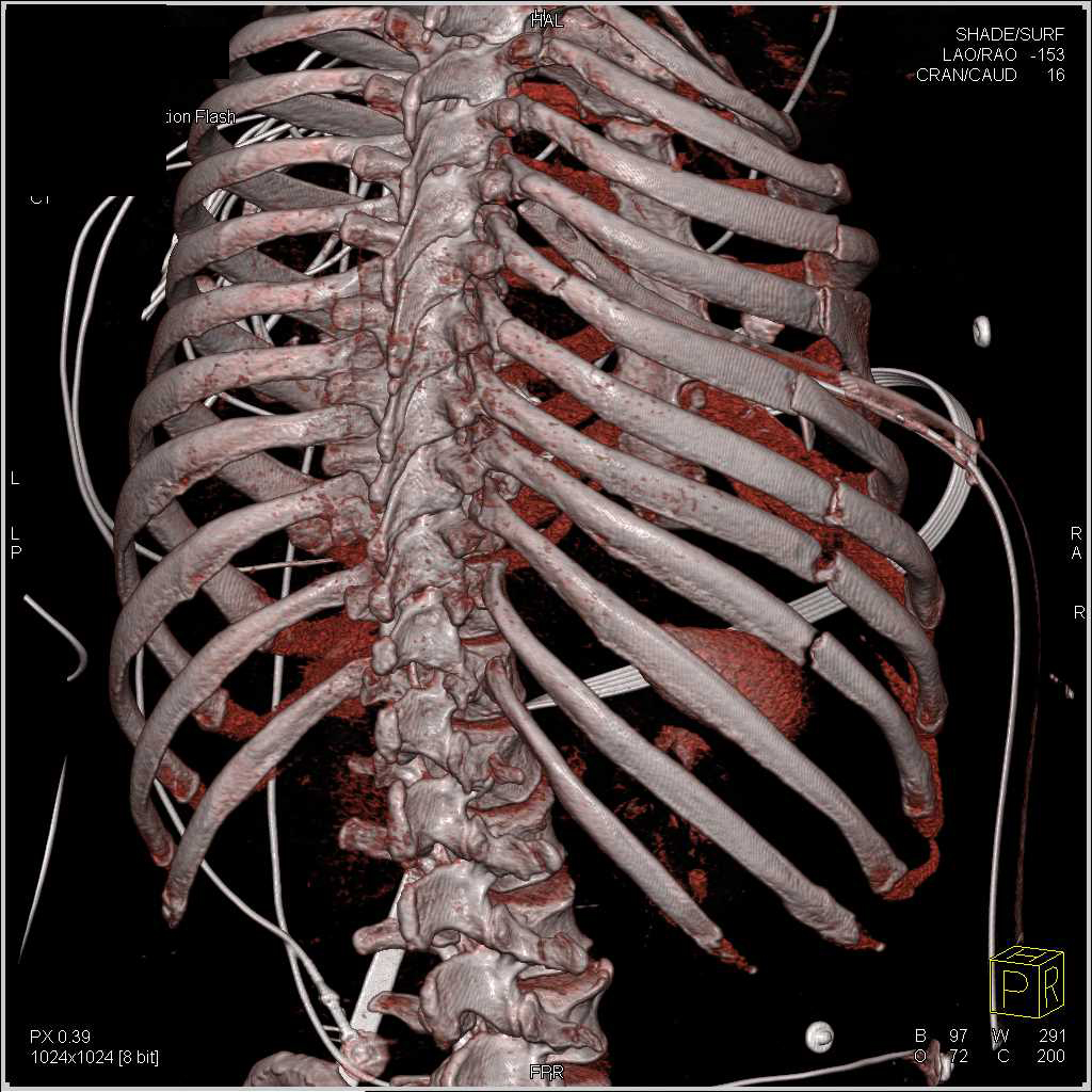 Multiple Rib Fractures - CTisus CT Scan
