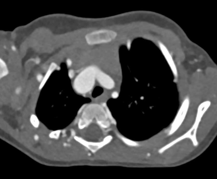 Coarctation of the Aorta with Extensive Collaterals - CTisus CT Scan