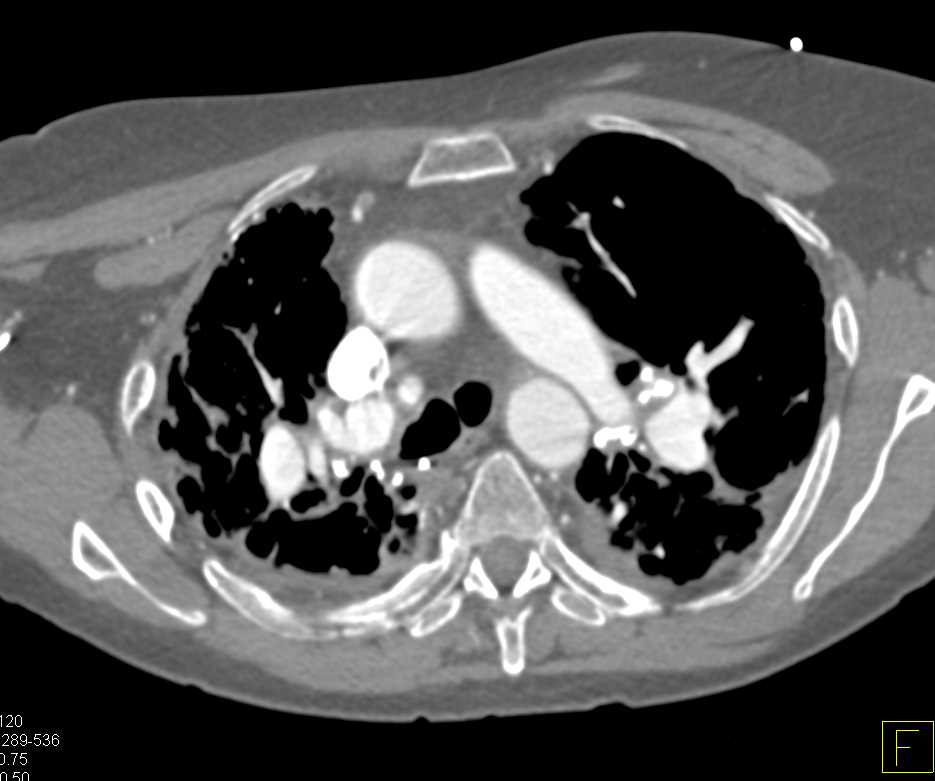 Sarcoidosis with Interstitial Fibrosis and Fungal Ball Left Upper Lobe - CTisus CT Scan