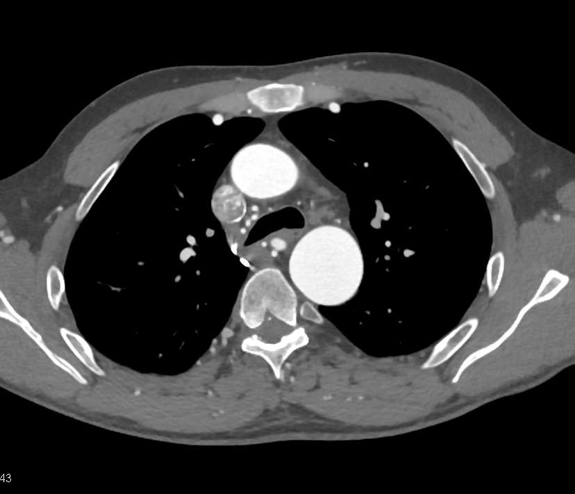 Dilated Bronchial Arteries - CTisus CT Scan