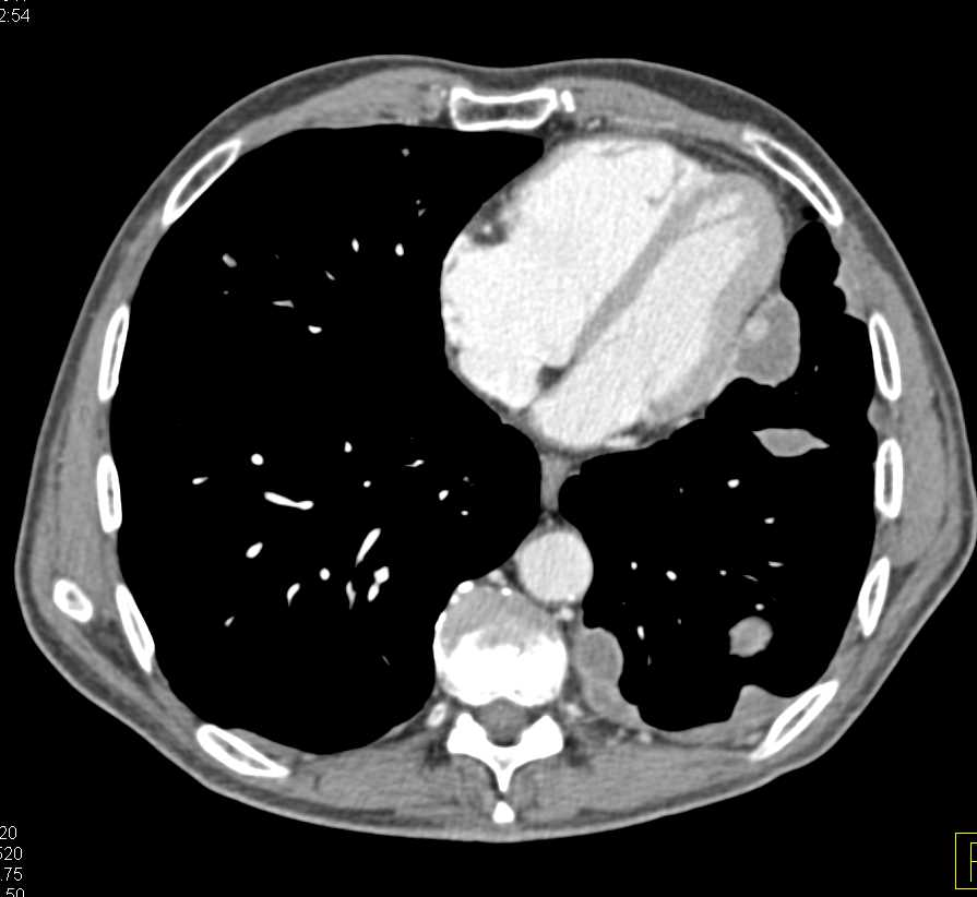 Pleural Implants from Thymoma - CTisus CT Scan