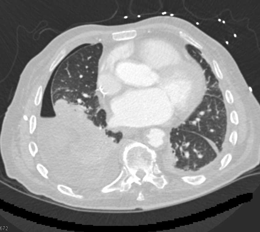 Chest Tube Placed in Liver - CTisus CT Scan