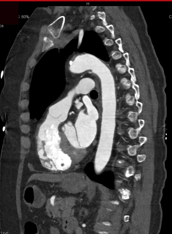 Ductus Bump with Calcification - CTisus CT Scan