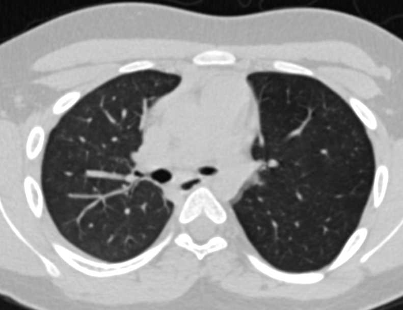 Stenosis of Left Mainstem Bronchus and Hyperinflation of the Left Lung - CTisus CT Scan