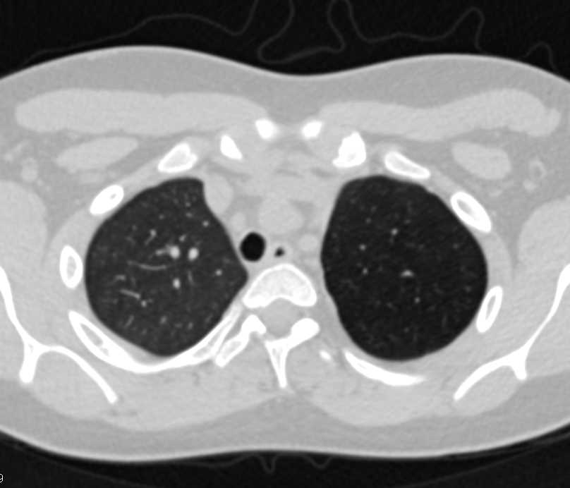 Stenosis of Left Mainstem Bronchus and Hyperinflation of the Left Lung - CTisus CT Scan