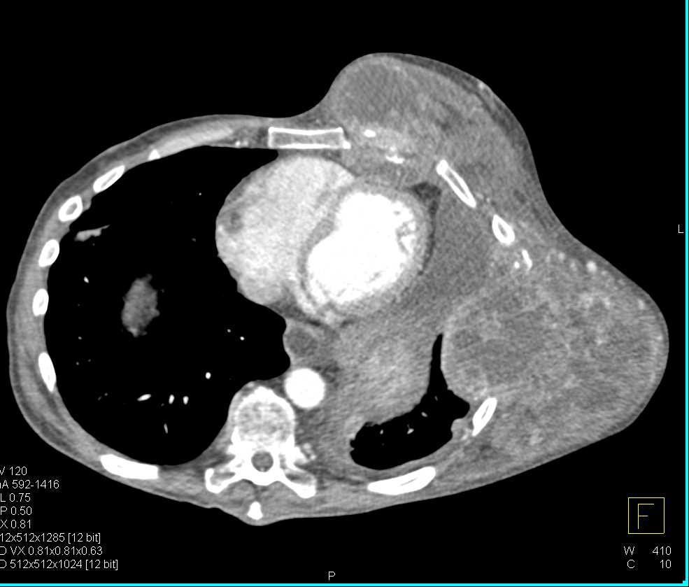 Sarcoma Involves the Chest Wall - CTisus CT Scan
