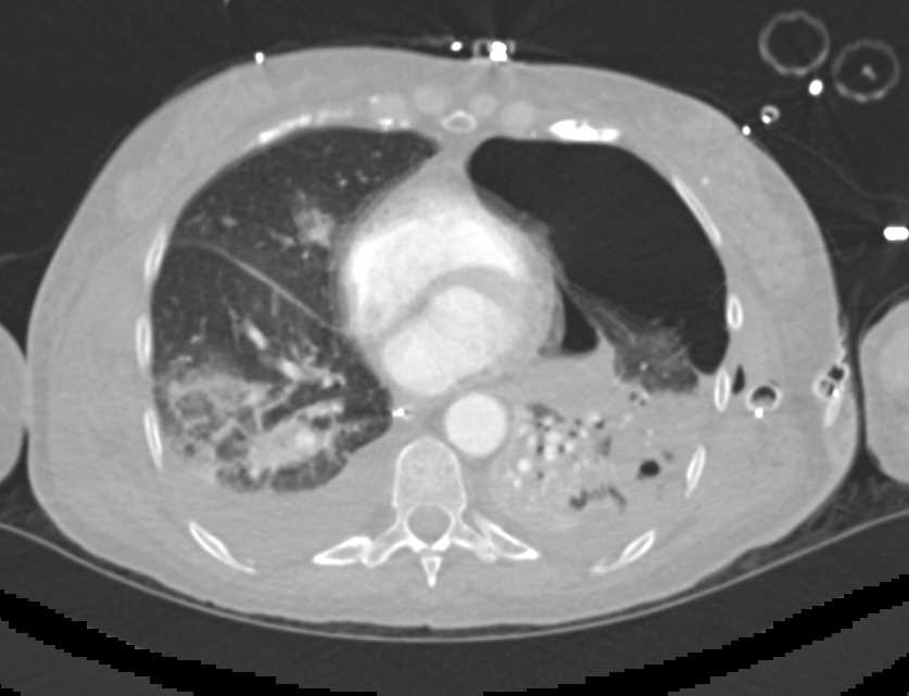 Pulmonary Contusion and Bleed Post Trauma - CTisus CT Scan
