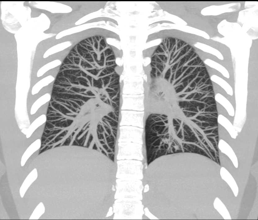 Sequestration Left Lower Lung with Air trapping - CTisus CT Scan