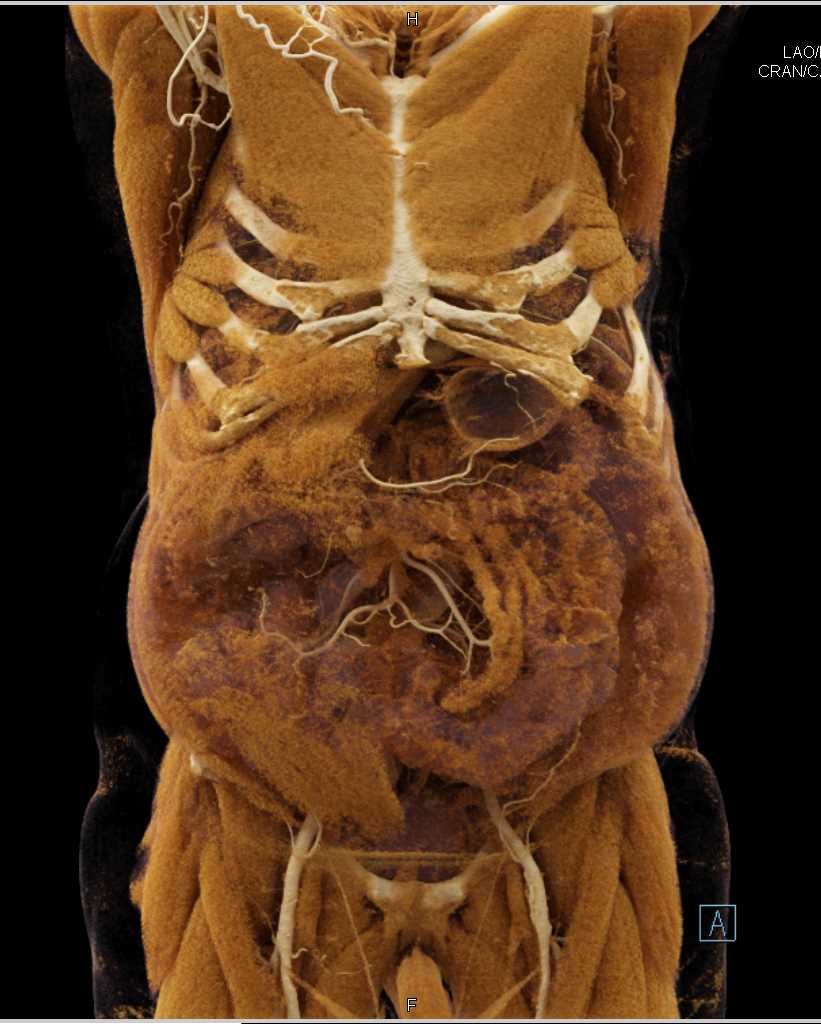 Cinematic Rendering of Chest and Abdomen - CTisus CT Scan
