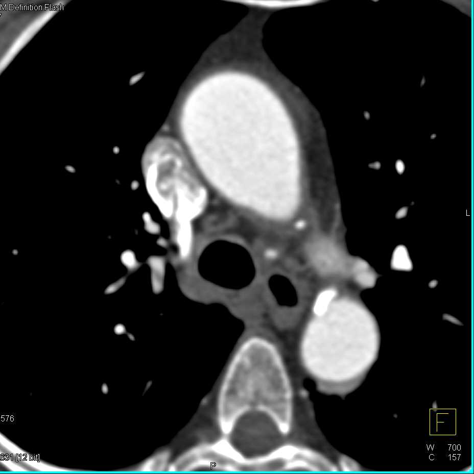 Pulmonary Embolism Right Lung - CTisus CT Scan