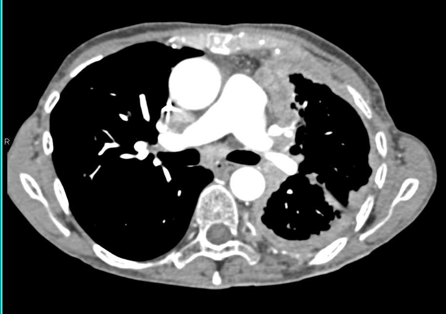 Mesothelioma - CTisus CT Scan