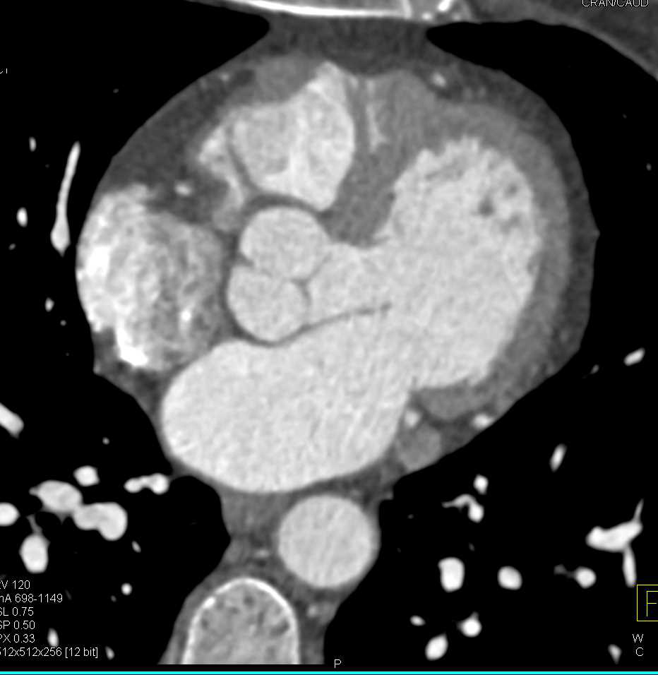Normal Ascending Aorta - CTisus CT Scan