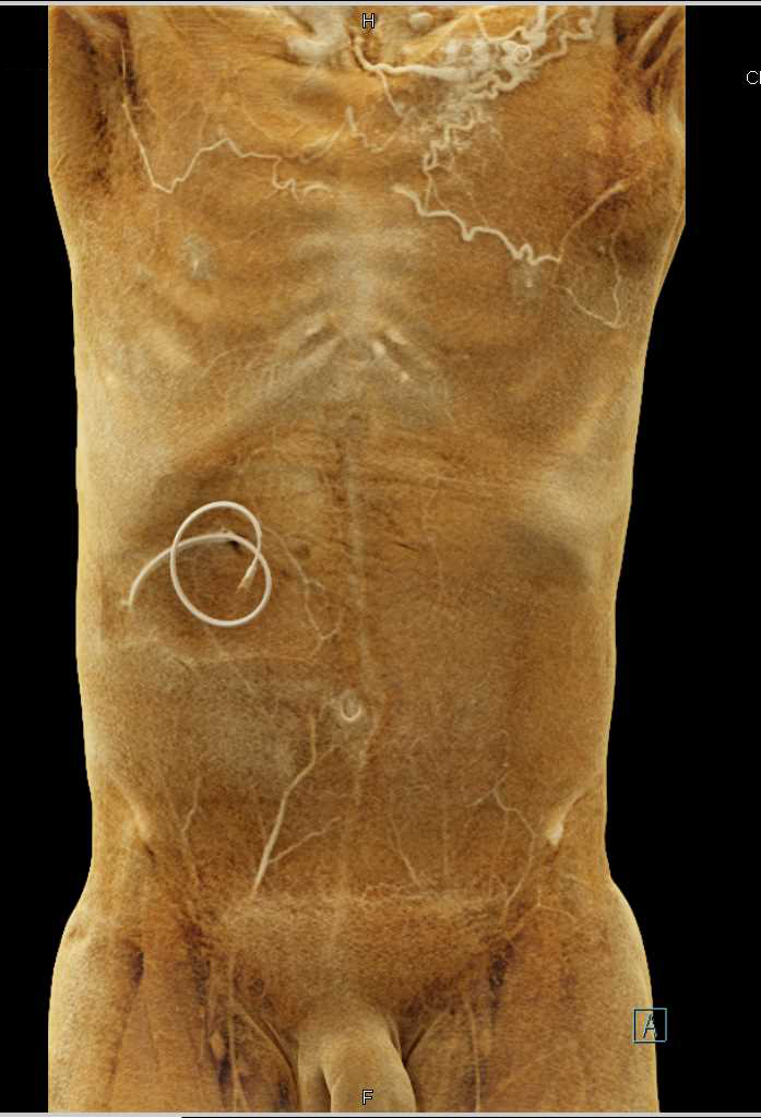 Metastatic Melanoma and Pulmonary Emboli (PEs) - CTisus CT Scan