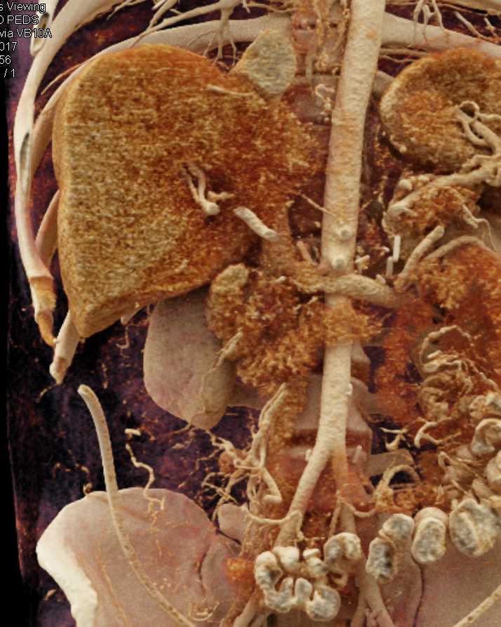 Metastatic Melanoma with Vascular Adenopathy - CTisus CT Scan