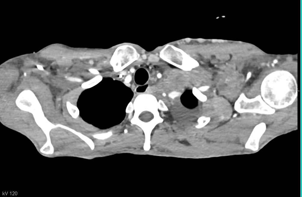 Metastatic Melanoma with Vascular Adenopathy and Pulmonary Embolism (PE) - CTisus CT Scan