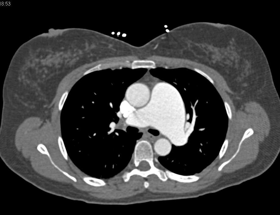 Aneurysmal Dilatation of the Main Pulmonary Artery - CTisus CT Scan
