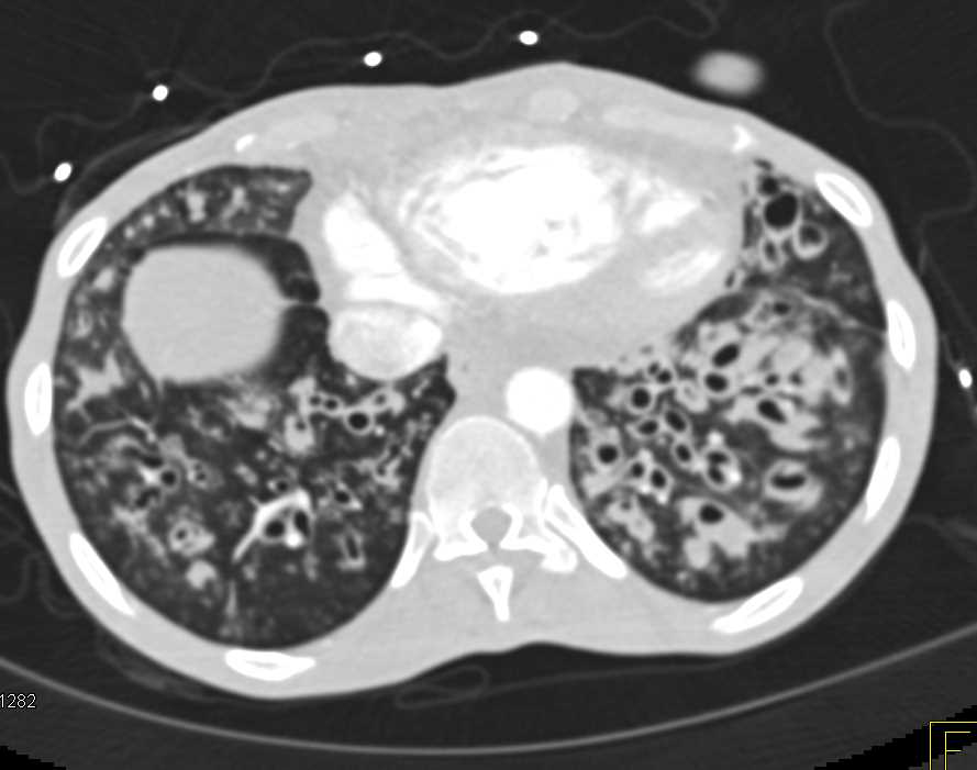 Bronchiectasis and Mucoid Impaction with Cystic Fibrosis - CTisus CT Scan