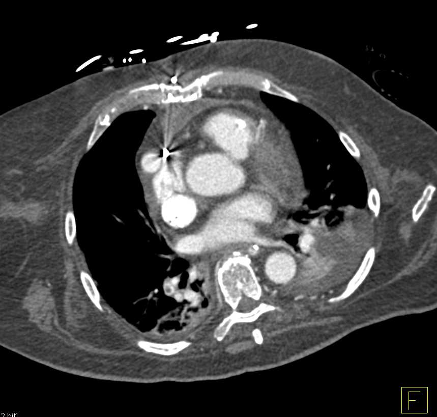 Left Ventricular Assist Device (LVAD) with Pulmonary Embolism (PE) - CTisus CT Scan