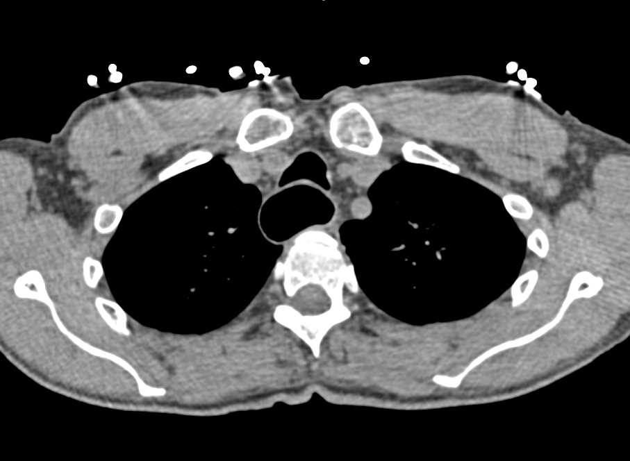 Severe Esophagitis with Pneumomediastinum - CTisus CT Scan