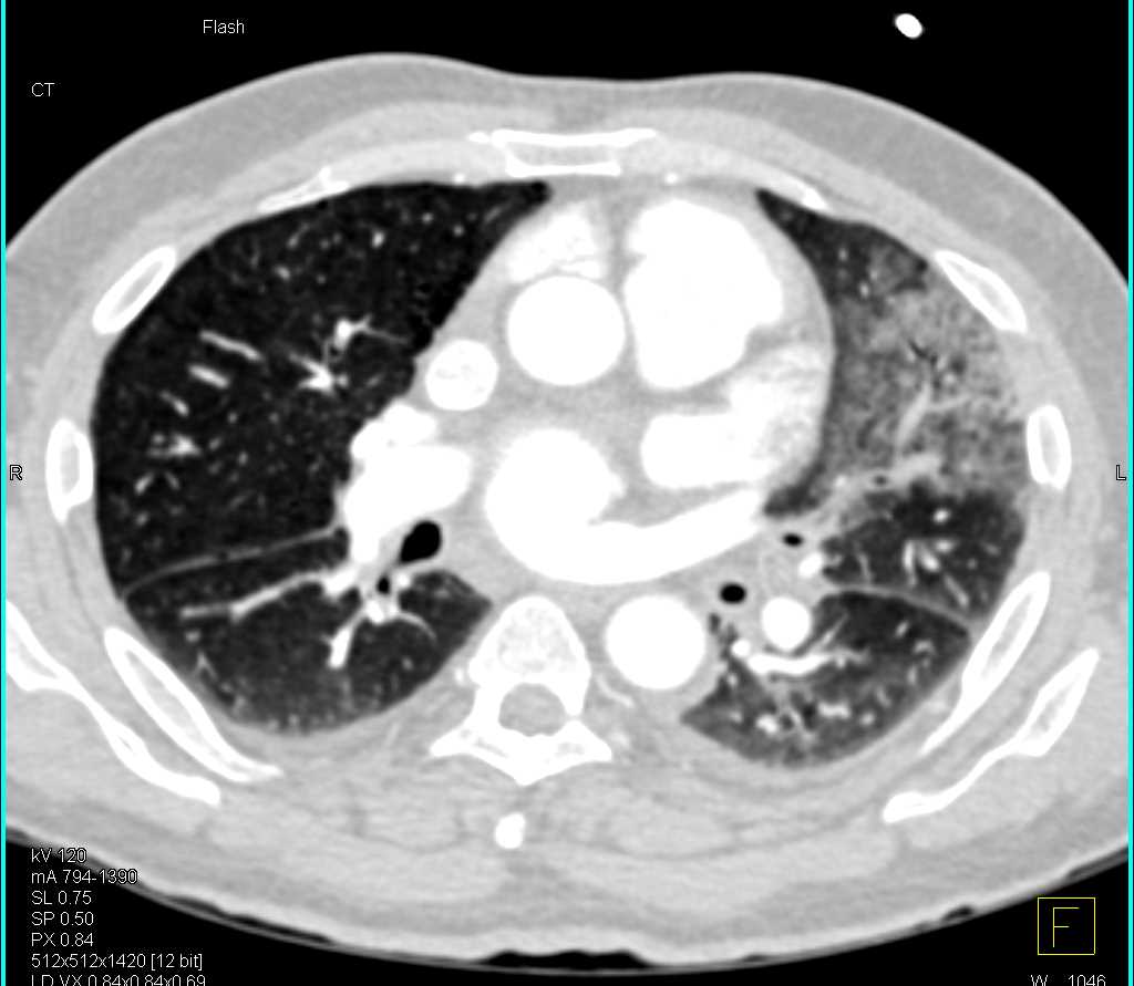 Multiple Pulmonary Emboli - CTisus CT Scan