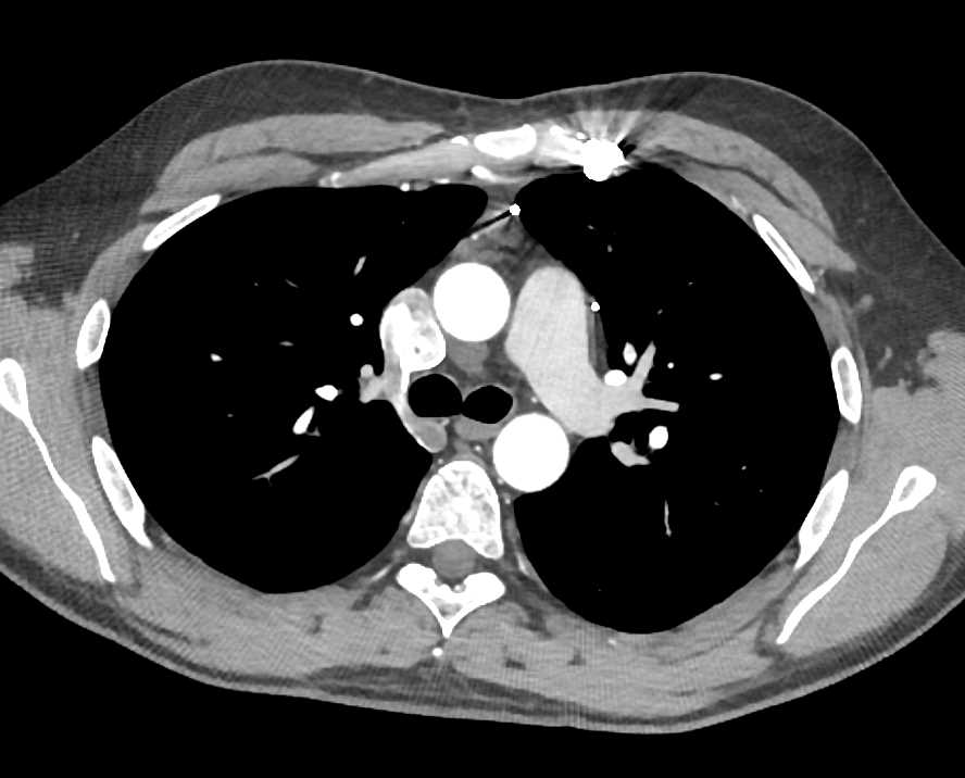 Pulmonary Arteriovenous Malformation (PAVM) Left Lung - CTisus CT Scan
