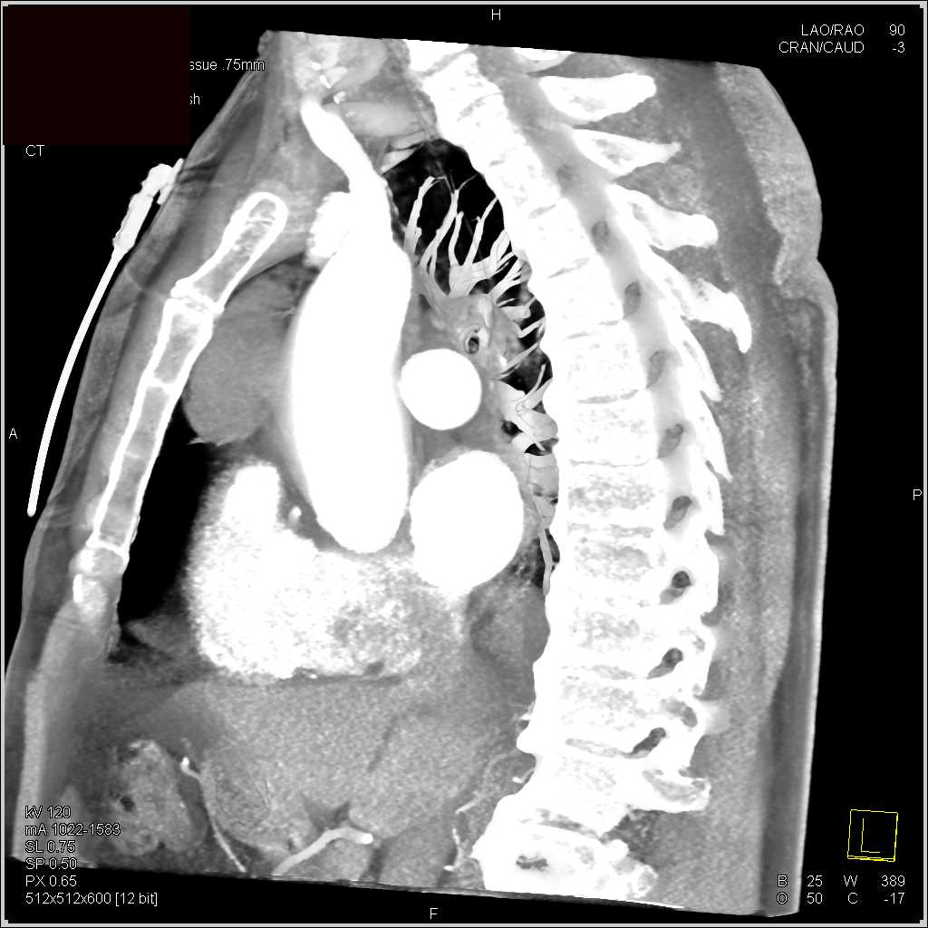 Thymic Cyst - CTisus CT Scan