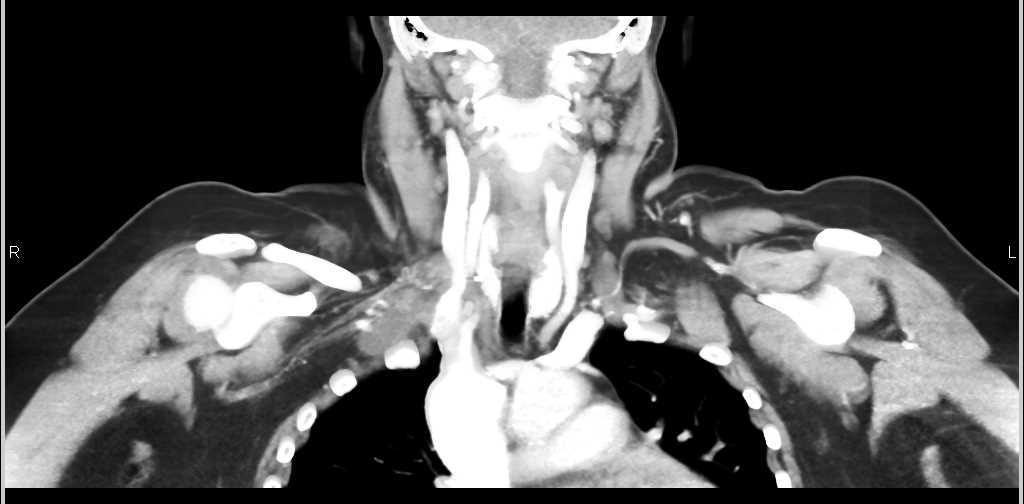 Inflammation Soft Tissue Above Right Lung Apex - CTisus CT Scan