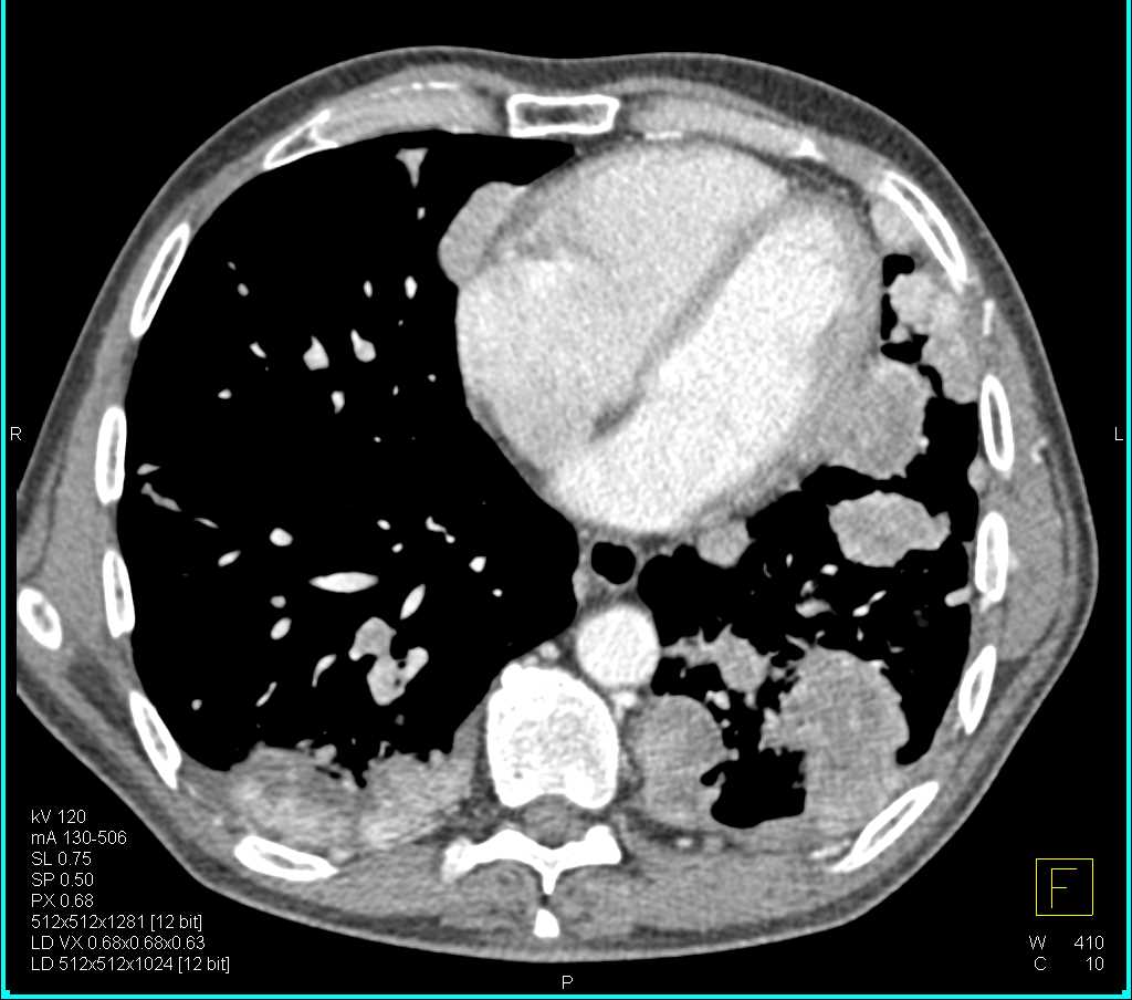Sarcoma Metastatic to the Lungs, Pleura and Adrenal Glands - CTisus CT Scan
