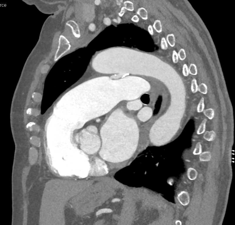 Patent Ductus Arteriosus (PDA) - CTisus CT Scan