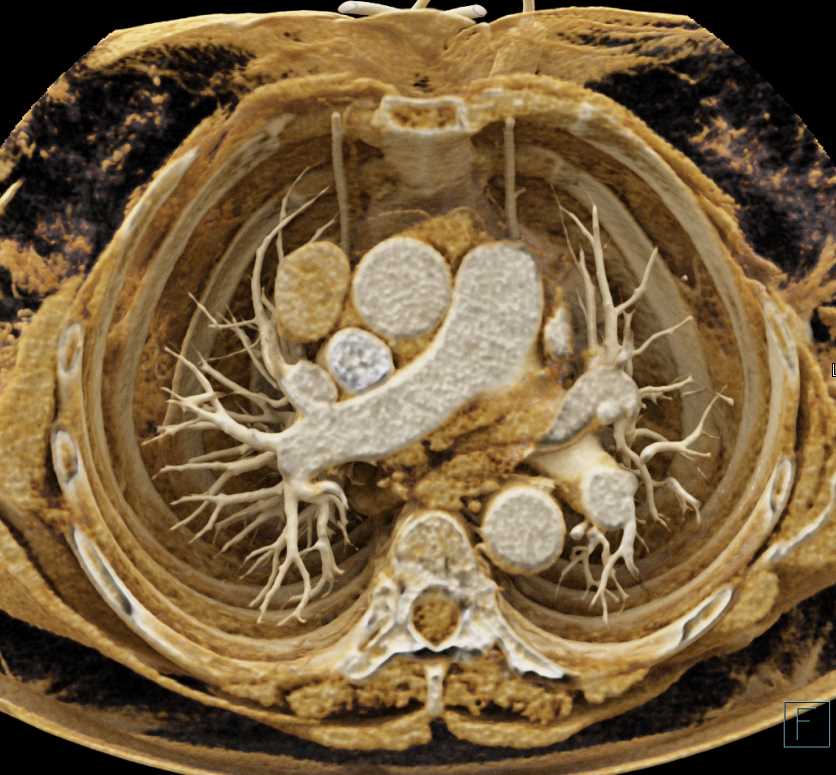 Pericardial Cyst with Cinematic Rendering - CTisus CT Scan