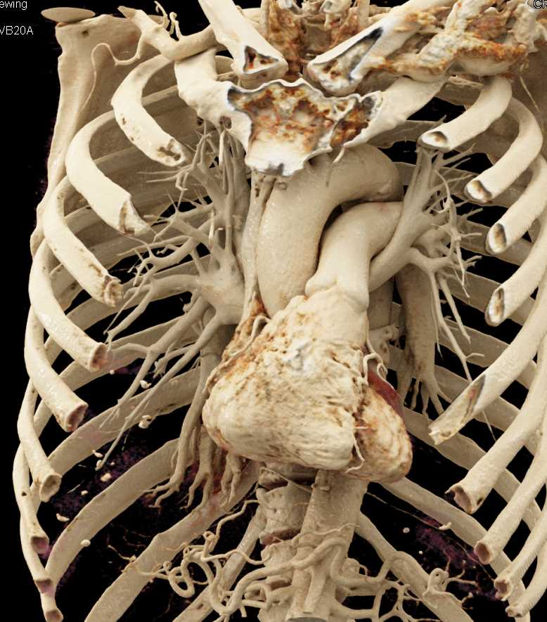 Cinematic Rendering at the Aorta Pulmonary Artery Interface - CTisus CT Scan