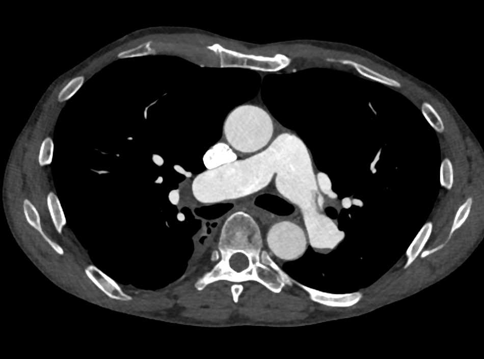 Bronchiectasis as well as Pulmonary Embolism - CTisus CT Scan