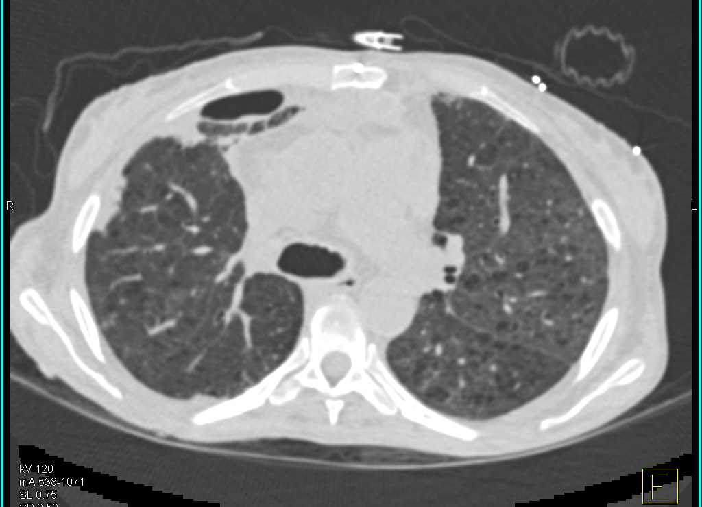 Cystic Changes Lung Fields and Infection - CTisus CT Scan