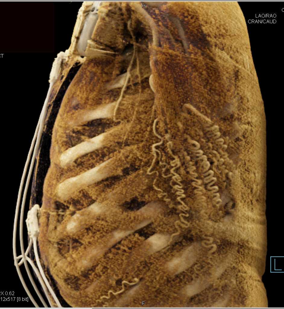 Dilated Internal Mammary Arteries - CTisus CT Scan