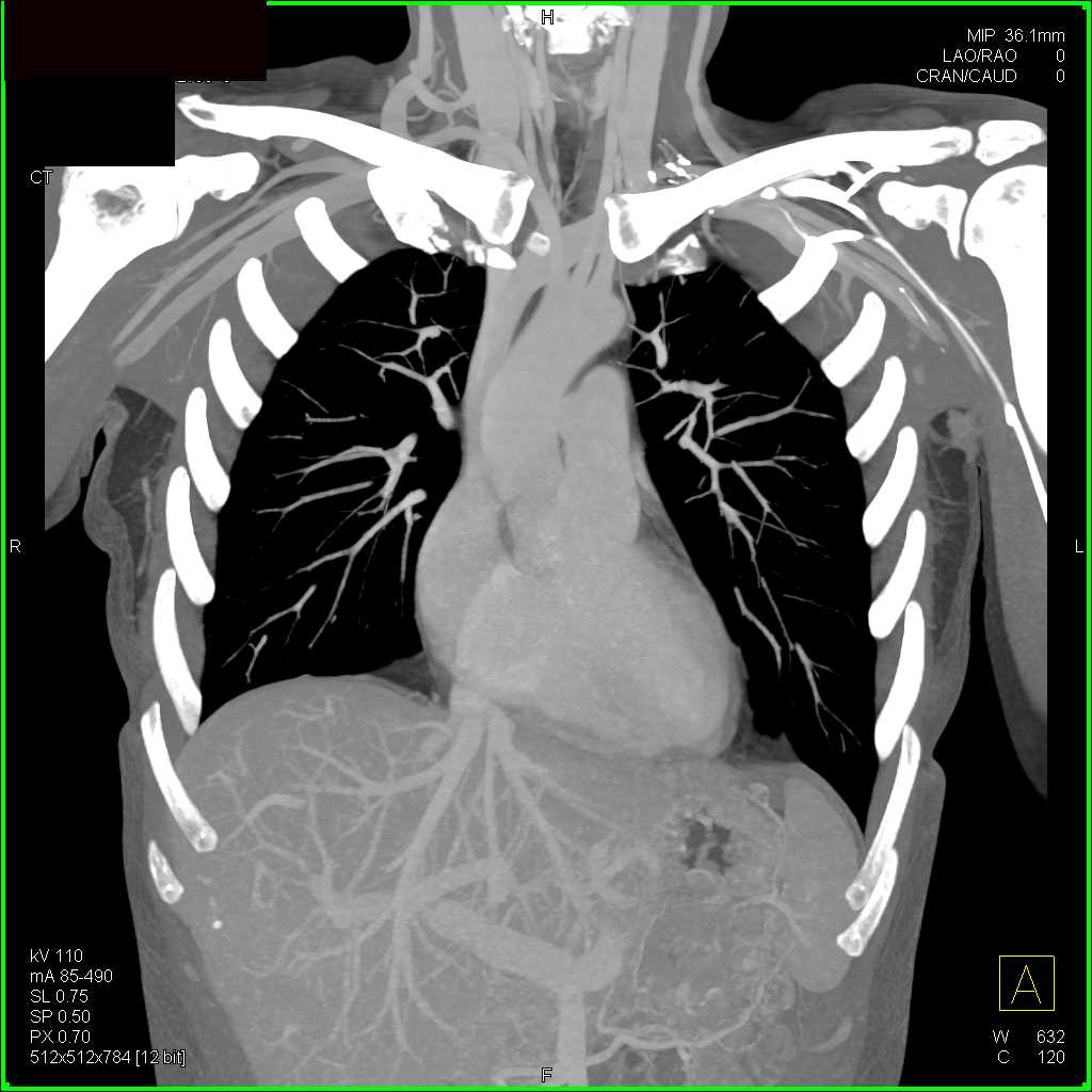 Vascular Mapping of the Thoracic Aorta - CTisus CT Scan