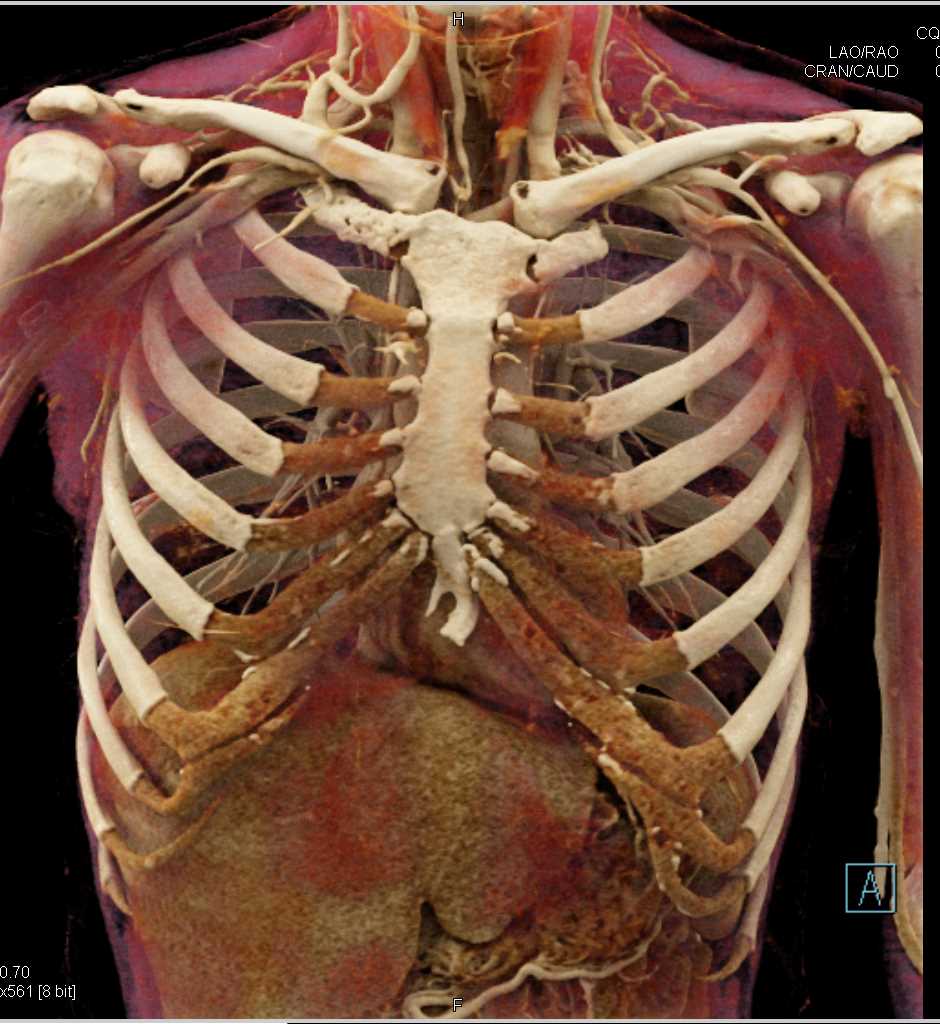 Vascular Mapping of the Thoracic Aorta - CTisus CT Scan
