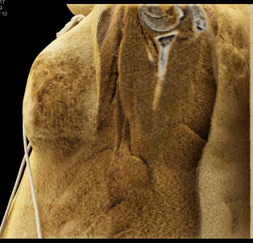 Chest Wall Anatomy with Cinematic Rendering - CTisus CT Scan