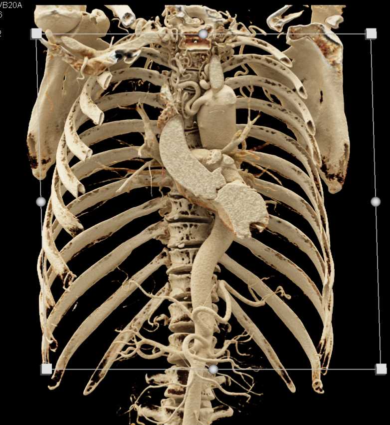 Coarctation of the Aorta with Multiple Collaterals - CTisus CT Scan