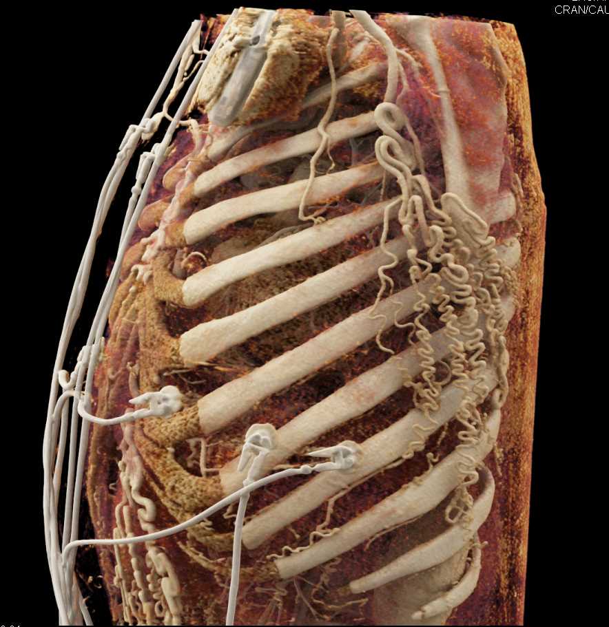 Extensive Collaterals with Dilated Internal Mammary Arteries - CTisus CT Scan