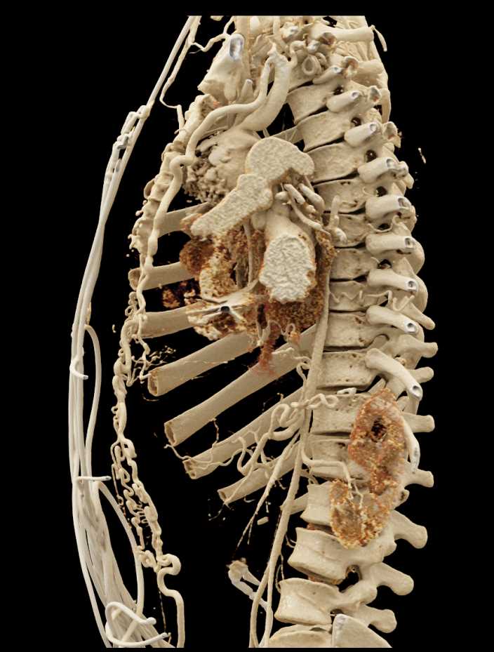 Extensive Collaterals with Dilated Internal Mammary Arteries - CTisus CT Scan